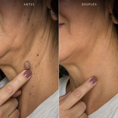 VerruZen® + Sérum Reparador GRATIS - Dile adiós a las verrugas desde casa