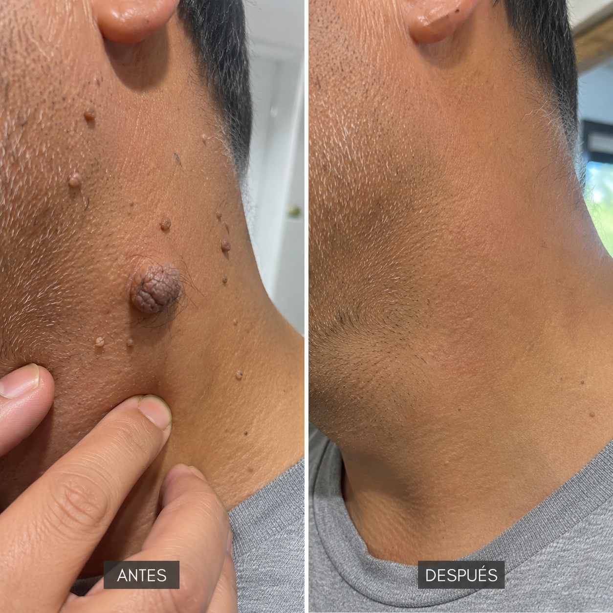 VerruZen® + Sérum Reparador GRATIS - Dile adiós a las verrugas desde casa